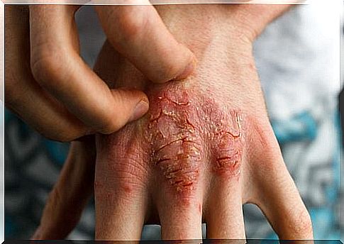 4 Remedies For Psoriasis In Children