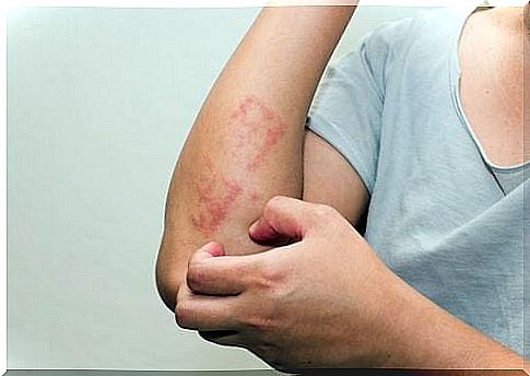 Psoriasis in children