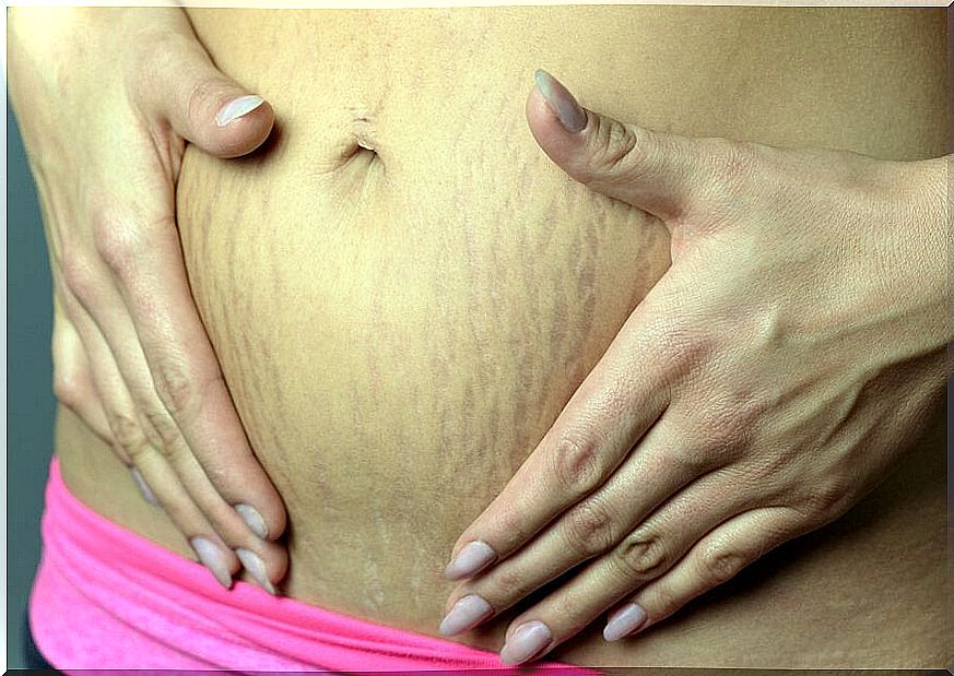 How to fight stretch marks during pregnancy