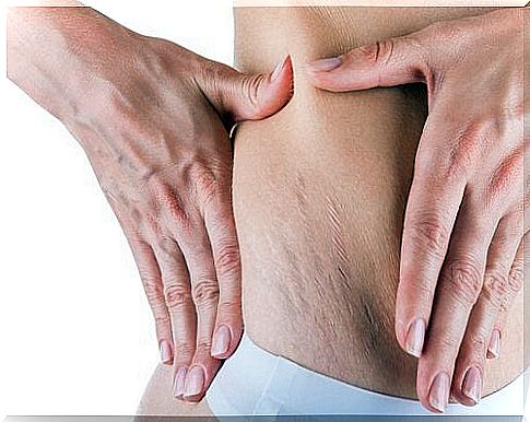 Keep your skin hydrated every day to prevent stretch marks during pregnancy