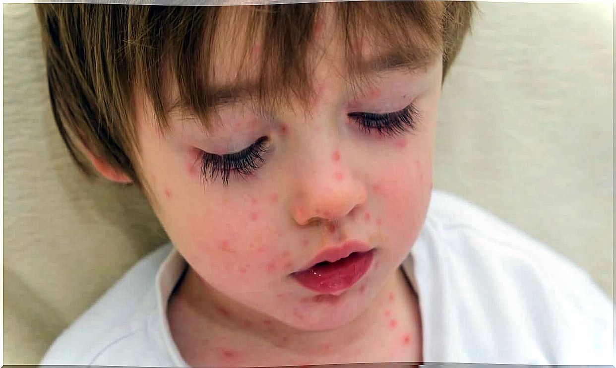 Read here what you need to know about scarlet fever