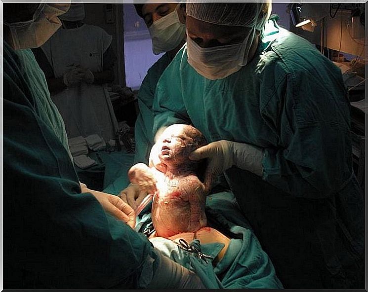 Having a cesarean section doesn't make you less of a mother